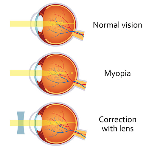 What is Nearsighted? | FramesDirect.com