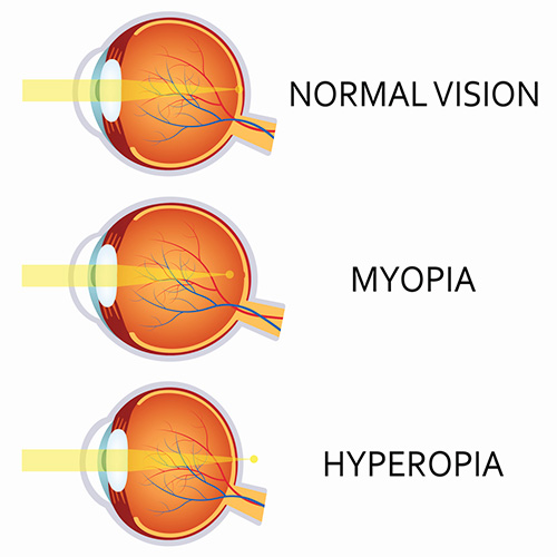 What Is Nearsighted? | FramesDirect.com